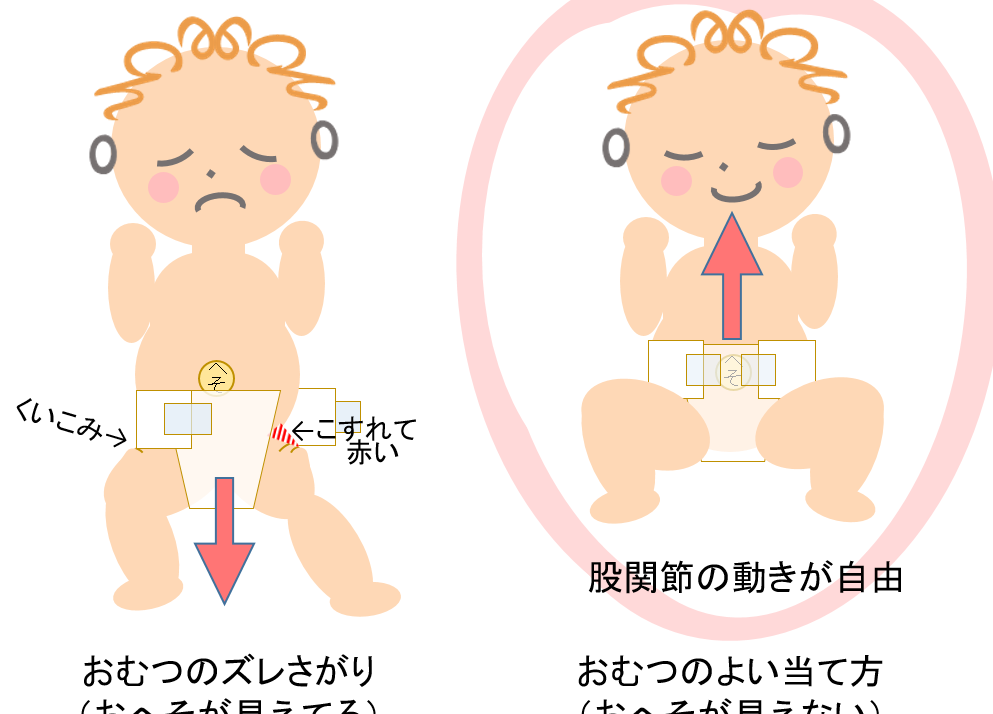 股関節脱臼 赤ちゃん しわ:発見のポイントと治療法、予防策 37 股関節脱臼 赤ちゃん しわ:発見のポイントと治療法、予防策
