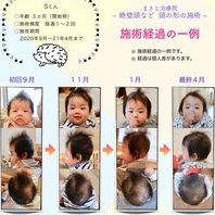 赤ちゃんの斜頭症!レベルと治療法 31 赤ちゃんの斜頭症!レベルと治療法