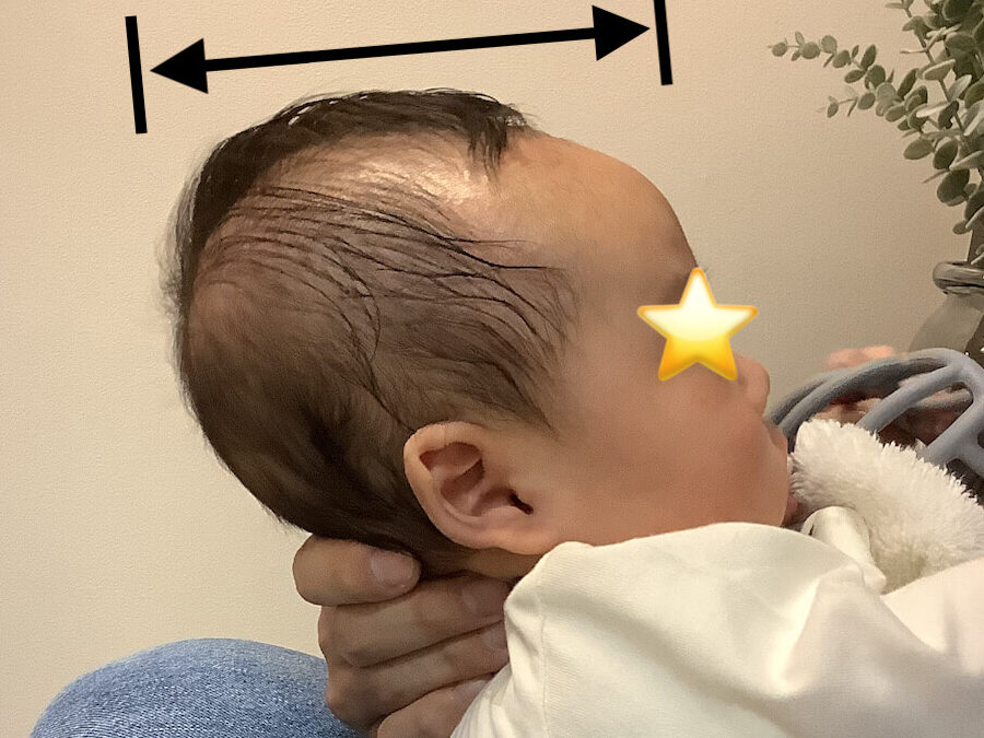 赤ちゃんの長頭症!原因と対策 16 赤ちゃんの長頭症!原因と対策