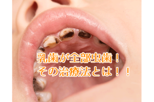子供 虫歯 ひどい 画像 - 進行した乳歯の虫歯の実例と予防方法 128 子供 虫歯 ひどい 画像 – 進行した乳歯の虫歯の実例と予防方法