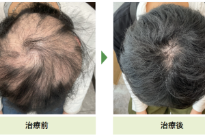 子供つむじはげの原因と対策:おさえておきたいケア方法 115 子供つむじはげの原因と対策:おさえておきたいケア方法