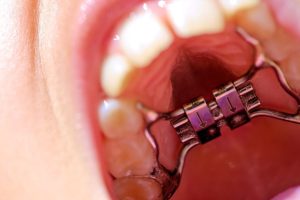 子供のための急速拡大装置の効果と利用方法: 急速 拡大 装置 子供 の全て 224 子供のための急速拡大装置の効果と利用方法: 急速 拡大 装置 子供 の全て