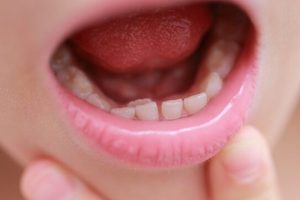 子供の永久歯が生えてこない!原因と対策法を徹底解説 93 子供の永久歯が生えてこない!原因と対策法を徹底解説