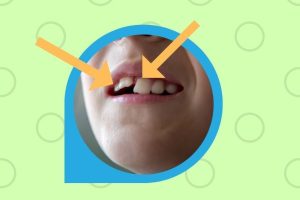 子供の永久歯の前歯が斜めになったらどうする?原因と対処法を徹底解説 110 子供の永久歯の前歯が斜めになったらどうする?原因と対処法を徹底解説