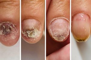 子供の深爪矯正:安全で効果的な方法と注意点 219 子供の深爪矯正:安全で効果的な方法と注意点