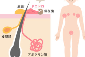 子供の耳垢がベタベタでワキガのような匂い?原因と対処法を徹底解説 109 子供の耳垢がベタベタでワキガのような匂い?原因と対処法を徹底解説