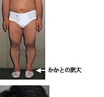 巨人症の子供の身長に関する情報 - 原因、症状、治療法と成長への影響 83 巨人症の子供の身長に関する情報 – 原因、症状、治療法と成長への影響